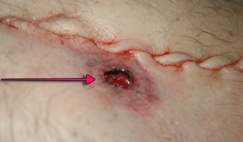 Firearms evidence - Post autopsy image of close contact entry wound.